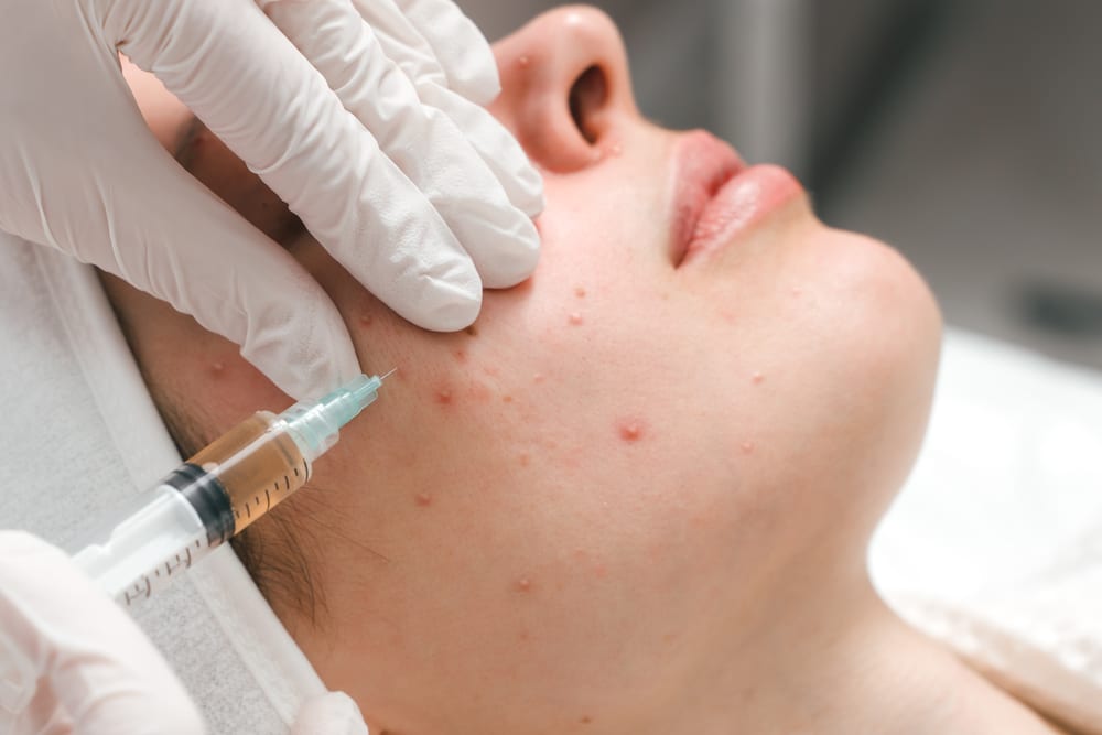 Clarifying Acne Facial