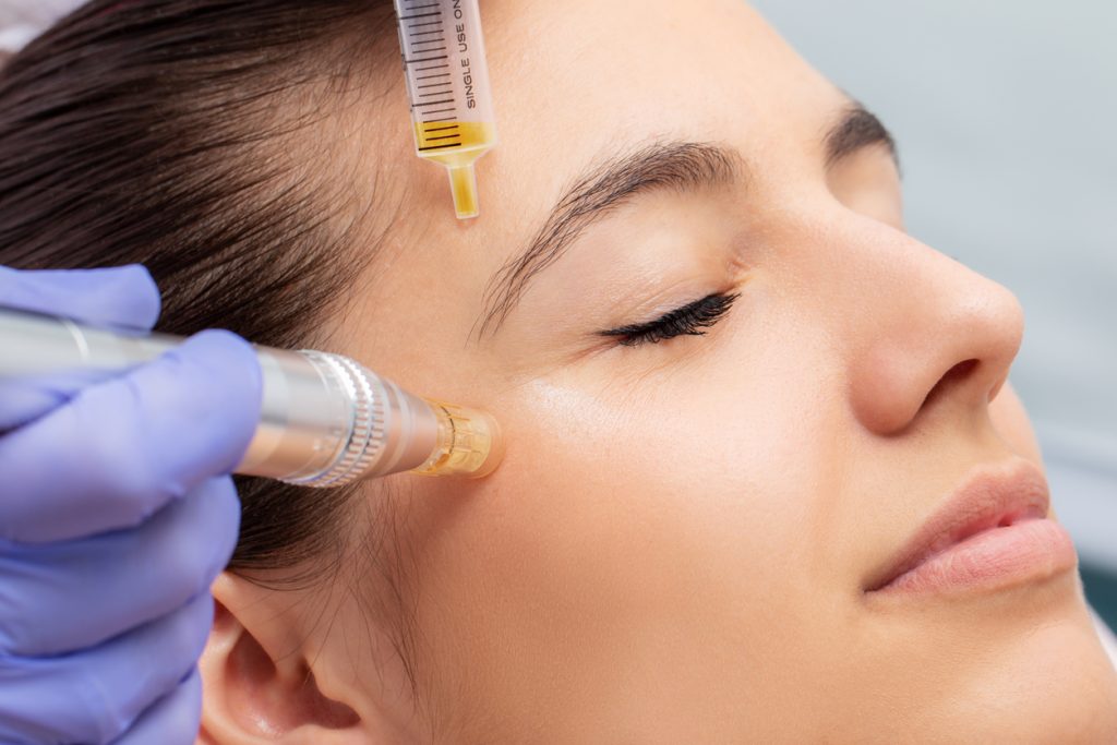 RF Microneedling con PRP